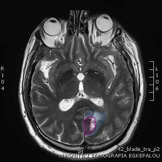 BrainTumor