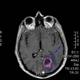 BrainTumor2