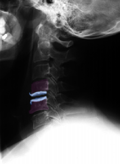 Cervicalarthroext