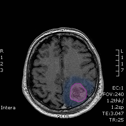 Glioblastoma2