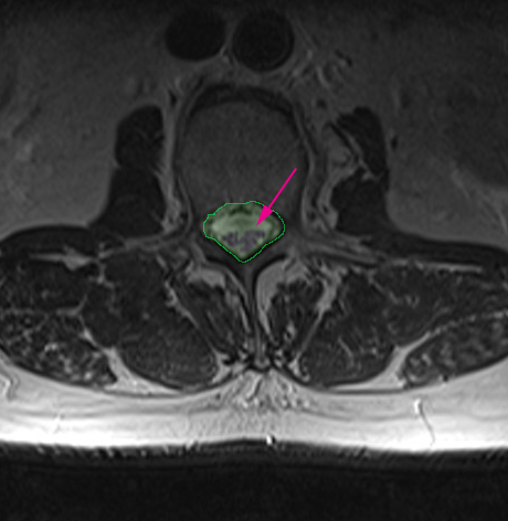 SpinalStenosisNormal