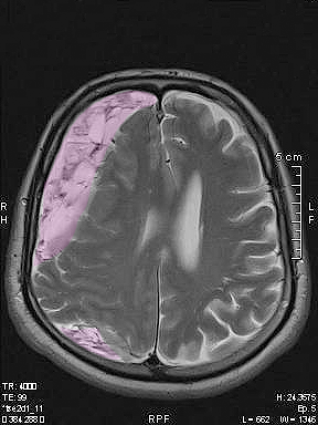 Subdural